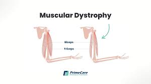 Image result for Muscular Dystrophy