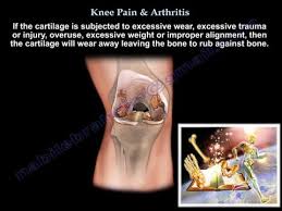 Knee Pain Knee Arthritis Treatment Everything You Need To Know Dr Nabil Ebraheim M D Youtube