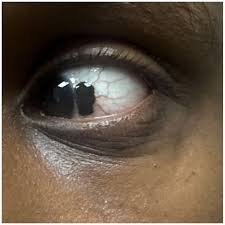 Image result for nevus sclerae