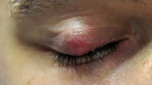 Approximately 5 to 10 percent of all skin cancers occur in the eyelid. Lump On Eyelid Is It Cancer Or Something Else