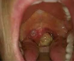 Throat cancer describes cancer of the voice box, the vocal cords, and other parts of the throat, such as the tonsils and the oropharynx. Throat Cancer By Michael Genzel
