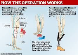 Here's why bone cancer must be the most painful of cancers. Boy Seven Who Lost His Leg Due To Cancer Gets Knee Made Using His Foot Daily Mail Online
