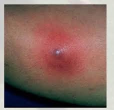 Why do spiders bite humans? Spider Bites Scary Skin Staph Stuff Orange County Pediatric And Sports Medicine Practice