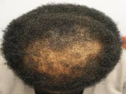 Baldness or hair loss in men is caused by fungal infections & psychological disorders. Patient 8 Hair Loss In Black Women Donovan Hair Clinic