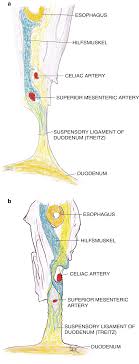Ligament of treitz ligamentum suspensorium duodeni. Superior Mesenteric Artery Syndrome Springerlink
