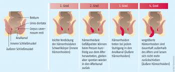 Muskelfaser — bauplan der skelettmuskulatur als muskelfaser (auch muskelfaserzelle oder myozyt) bezeichnet man die zelluläre, spindelförmige grundeinheit eines skelettmuskels. Es Schmerzt Beim Stuhlgang