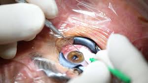 Ist euer sprössling eher leichtsinnig, lässt sich schnell ablenken und besitzt noch nicht viel pflichtbewusstsein, dann ist es noch nicht reif genug für kontaktlinsen. Klare Sicht Ohne Brille Was Eine Laser Op Bringt Gesundheit