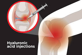 Temporary flare of pain and inflammation in the joint 7. Hyaluronic Acid Injections How Do They Treat Arthritis