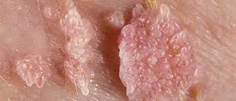 Image result for genital warts