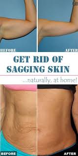 Natural Sagging Skin Home Remedy 9 Leading Diy Home Remedies For Skin Tightening And Sagging Home Remedies For Skin Sagging Skin Crepey Skin