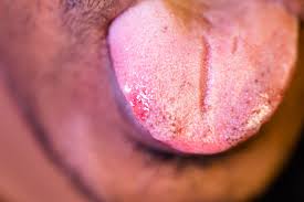 Image result for white cancer on tongue)