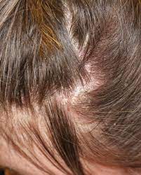 The scalp surface was examined by dermatoscopy. Help For An Itchy Crown And Hair Loss Following Emotional Trauma