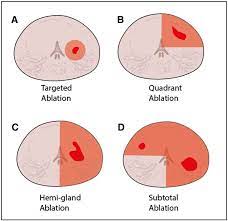 The pancreas is located behind the stomach, so having pancreatic cancer doesn't involve a palpable mass that you can feel. Focal Laser Ablation As Clinical Treatment Of Prostate Cancer Report From A Delphi Consensus Project Springerlink