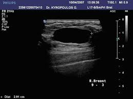 Pin On Breast Cyst
