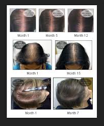 Different hair types for haircuts near me. Hair Loss Treatment Service In Faridabad Sec 3 Housing Board By Dharam Hair Salon Id 19010042455