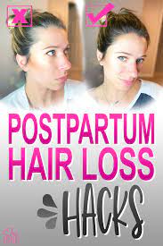 Postpartum Hair Loss Help Tips From A Cosmetologist Postpartum Hair Loss Baby Hair Loss Postpartum Hair Loss Remedies