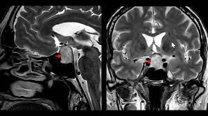 Hypophysenadenom Neurochirurgie Inselspital Bern