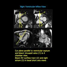 Pseudo 2 4 Chamber Views Short Axis View 4 Chamber View Left 2 Chamber View 3 Chamber View Left Ventricular Outflow Tract Cardiac Medical Ultrasound Mri