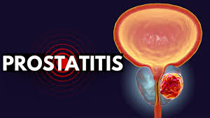 Image result for Acute Bacterial Prostatitis