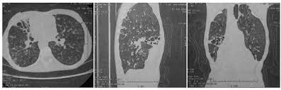 Secuelas estructurales y funcionales de tuberculosis pulmonar ...