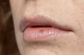 Image result for Lip Cancer