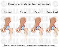 Hip Fai Medium Jpg 400 320 Impingement Syndrome Impingement Hip Surgery