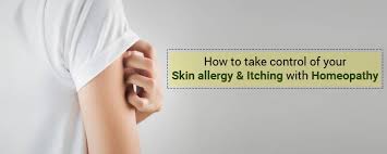 Homeopathy medicine skin rash pimples healing thyroid india medical thyroid gland. How To Take Control Of Your Skin Allergy Itching With Homeopathy Schwabe India