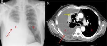 Positron emission tomography/computed tomography for the pleural staging of malignant pleural mesothelioma: Malignant Pleural Mesothelioma And Its Management Bja Education