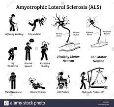Amyotrophe lateralsklerose (als) ist nicht heilbar. Amyotrophe Lateralsklerose Als Krankheit Anzeichen Und Symptome Abbildungen Zeigen Nervensystem Oder Neurologische Erkrankung Bei Als Patienten Stock Vektorgrafik Alamy