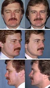 The Angry Face Syndrome