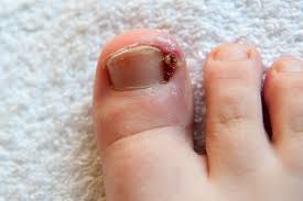 Image result for Toenail Removal