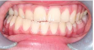 This is usually done for 1 to 2 weeks. The Difference Between A Crossbite And Overbite Mcdonough Ortho
