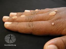 Image result for skin rash acute hiv infection