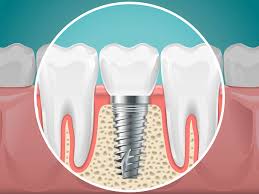 Image result for dental implant
