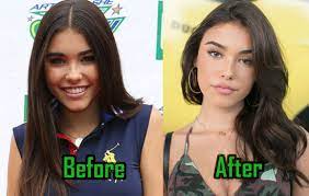Singer madison beer has finally taken to twitter and addressed rumors that she got work done after photos of her at a plastic surgeon surfaced online. Madison Beer Plastic Surgery Of Nose Boob Job Celebritysurgeryicon