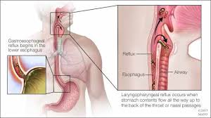 Image result for Reflux Laryngitis