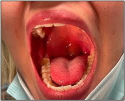 Image result for Angioedema