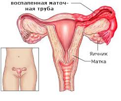 Durerile de ovare în sarcină. InflamaÅ£ia Anexelor Uterine Anexita Ooforita Salpingooforita InflamaÅ£ia Ovarelor Si A Trompelor Uterine