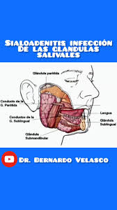 Image result for Sialoadenitis