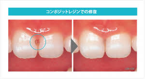 歯がしみる8つの原因と自宅 歯医者での治療法 ハイライフグループ