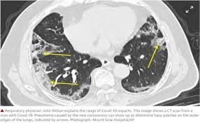 Drawing Insights From Covid 19 Infected Patients Using Ct Scan Images And Machine Learning Techniques A Study On 200 Patients Springerlink