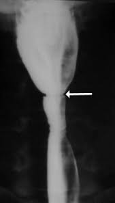 Plummer vinson syndrome is a constellation of postcricoid esophageal webs, iron deficiency anemia, dysphagia and koilonychia. Esophageal Web An Overview Sciencedirect Topics