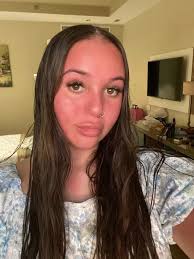 Woman left 'looking like tomato' and thought face would 'explode' after  sleeping in sun