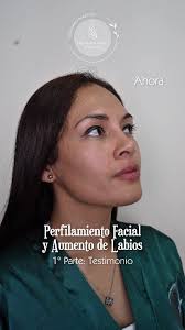 ✨️1° ᴾᵃʳᵗᵉ✨️ ᴘᴇʀꜰɪʟᴀᴍɪᴇɴᴛᴏ ꜰᴀᴄɪᴀʟ, ¡Resalta tu belleza natural con el  perfilamiento facial utilizando @divineusacidohialuronico, aplicado por el  reconocido y experimentado Dr. Fernando Carpio 💉✨, 𝗗𝗥. ...