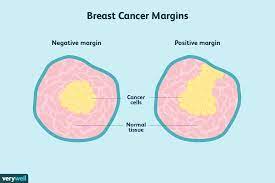 Whenever any surgeon is doing any surgery.for eg for any cancer,he remove say for eg. Understanding Surgical Margins In Breast Cancer