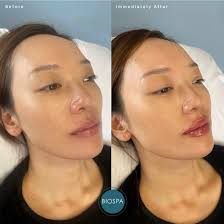 Exciting news! BioSpa was officially named a Top 5 miraDry Provider in  North America for 2024, and so far, we're holding strong as a Top 3  Provider for 2025! 🙌 What does