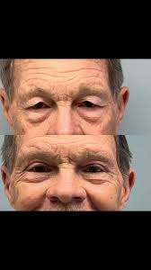 Before & After Brow lift and upper eyelid Blepharoplasty. #browlift  #blepharoplastysurgery