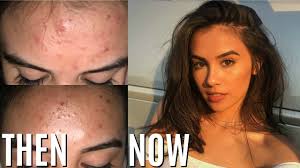 We did not find results for: How To Really Get Rid Of Acne In One Week Works Youtube