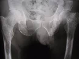 Chondrosarcoma is a cancer that can begin in the bones or tissue near bones, often in the hip, pelvis, and shoulder. Surgery For Metastatic Bone Disease Uw Orthopaedics And Sports Medicine Seattle
