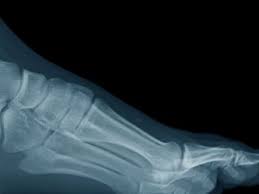 Image result for Ankle XRay